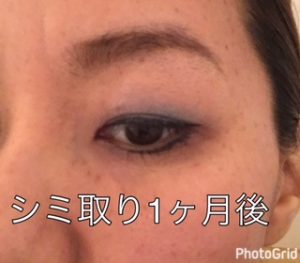 シミよさようなら 名古屋でしわ たるみ しみ治療が得意なラベールミラクリニック