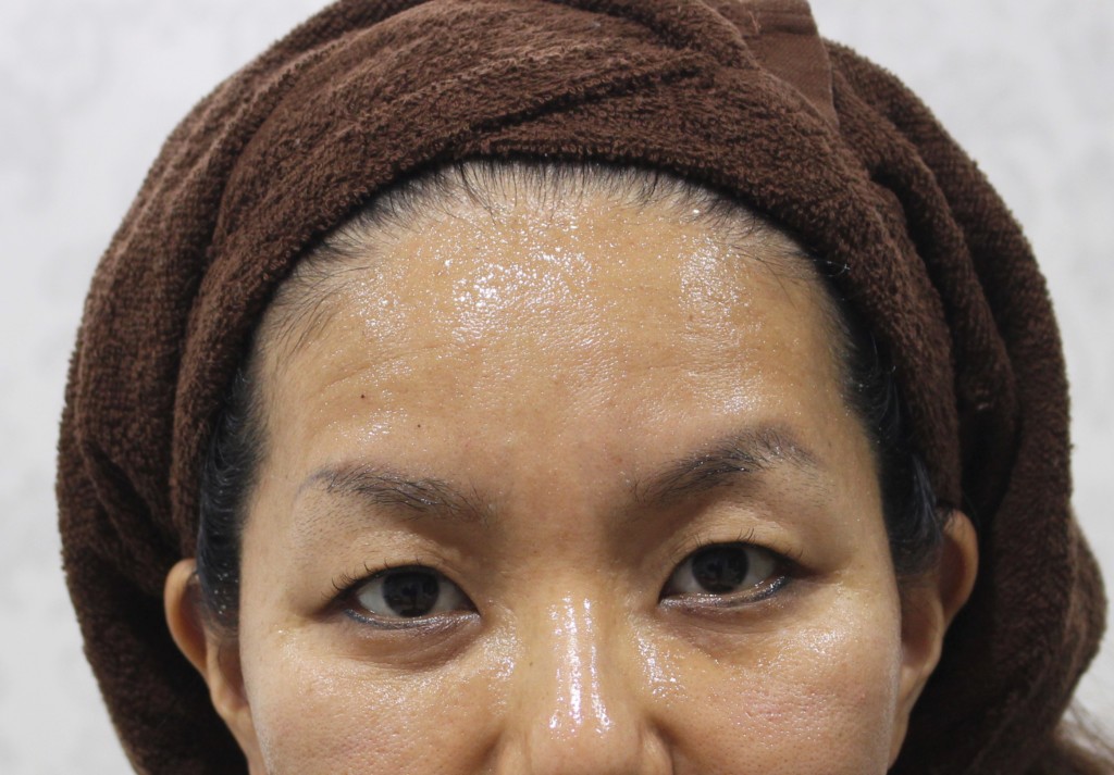 院長ブログ おでこのヒアルロン酸注入ビフォーアフター 名古屋でヒアルロン酸 ボトックス注射注入が得意なラベールミラクリニック