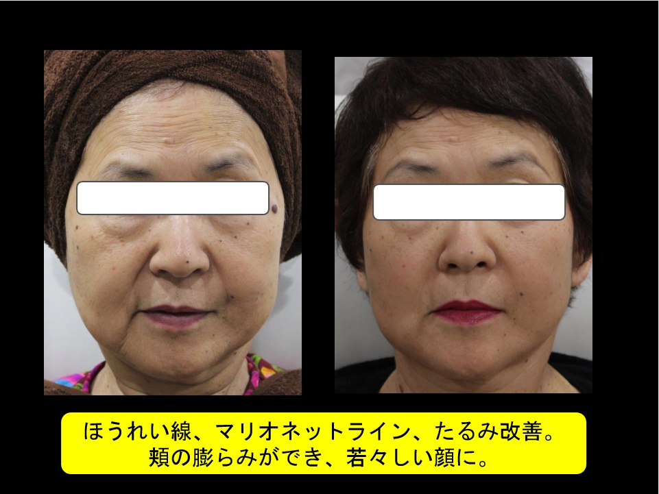 ヒアルロン酸リフト60代