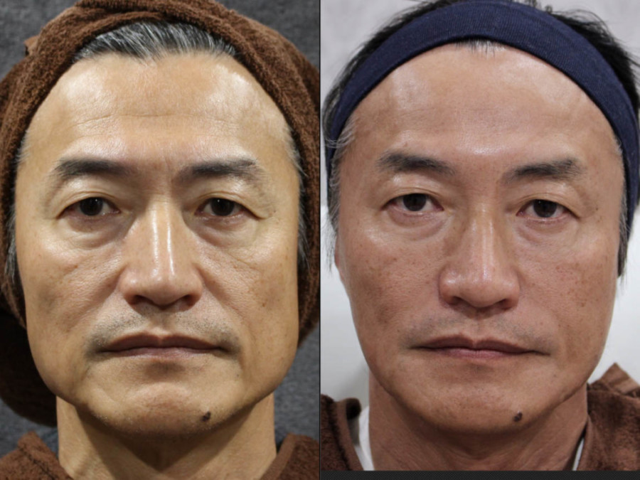 たるみ 名古屋でしわ たるみ しみ治療が得意なラベールミラクリニック