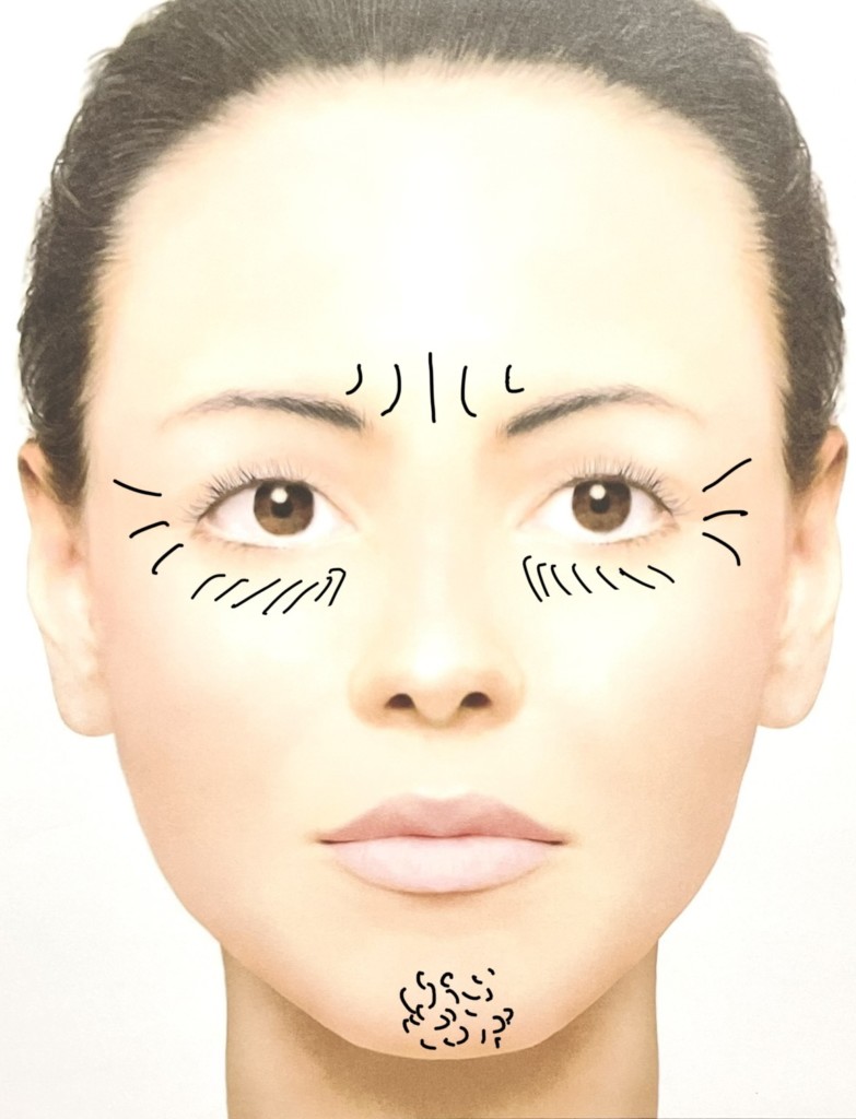 ヴィジョン・ド・ボーテ12個セット塗るボトックスおでこや目尻のシワに